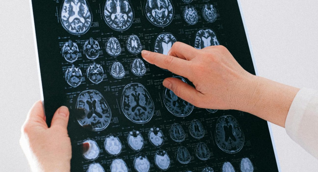 Afectiuni cerebrale tot mai frecvente in Romania Alarma medicilor